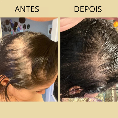 BOTANIL – CRESCIMENTO CAPILAR – RESULTADOS VISÍVEIS EM 3 SEMANAS